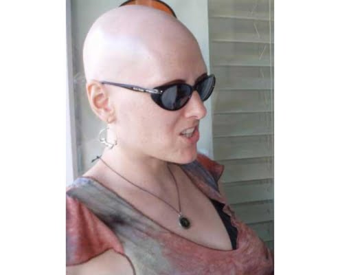 alopecia totalis